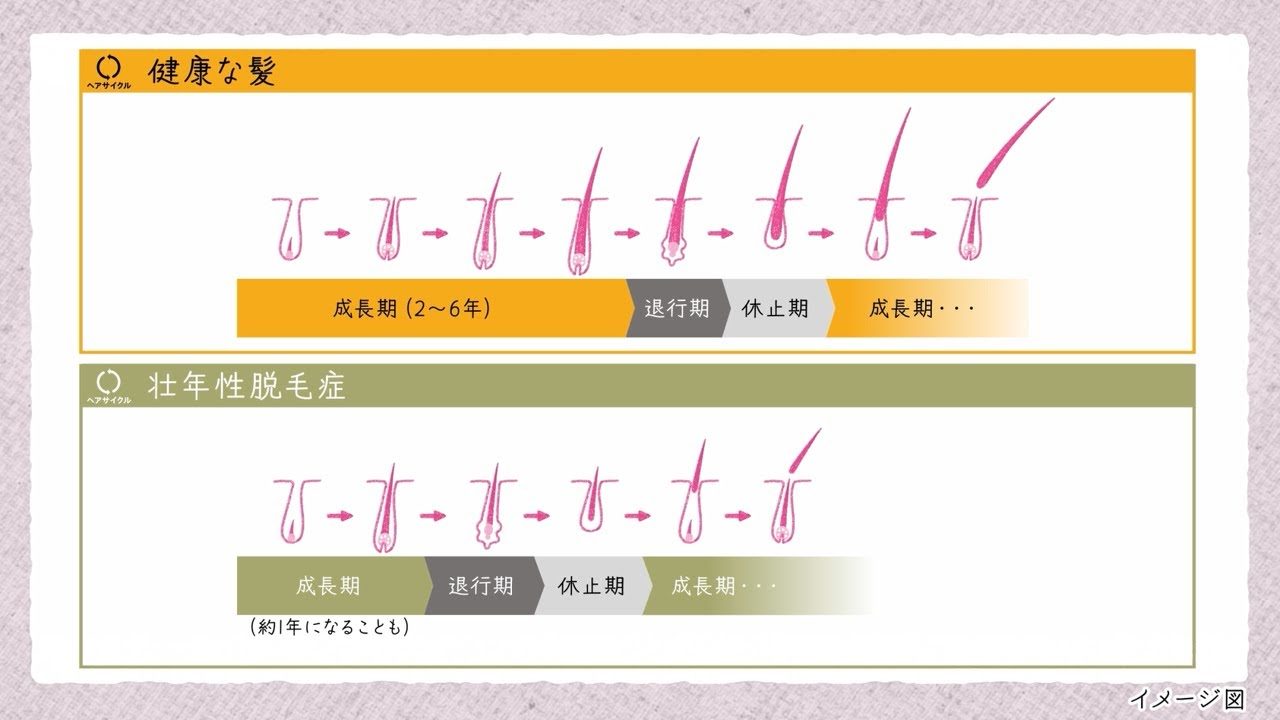 「健康な髪」と「壮年性脱毛症の髪」の違い