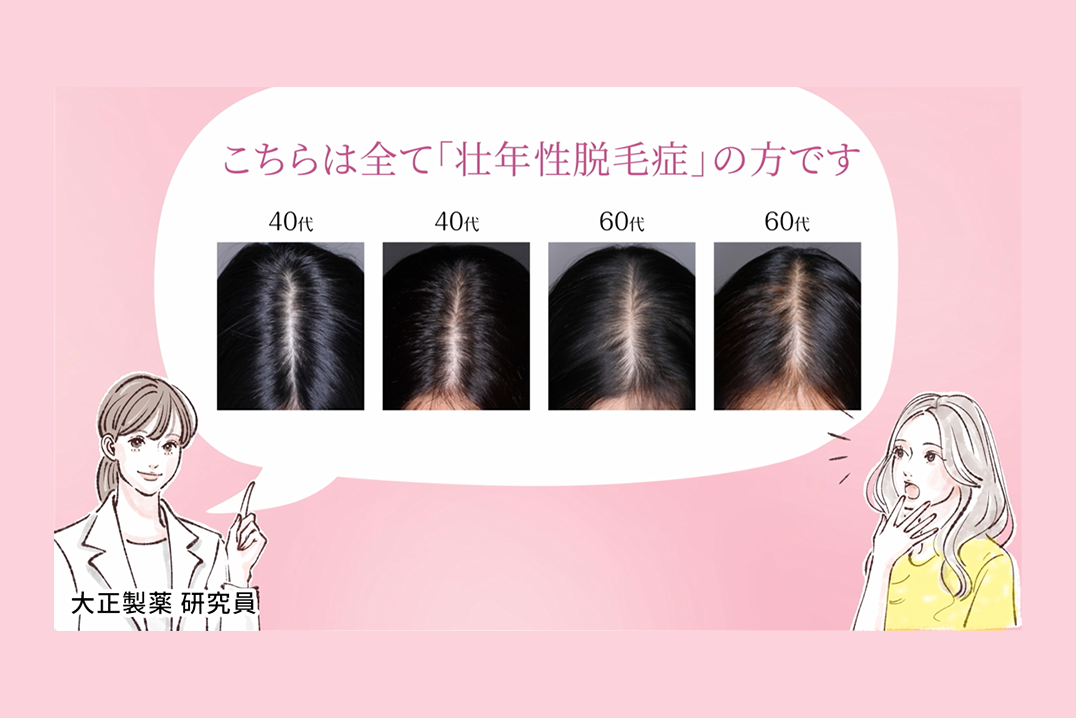 薄毛が気になる女性必見！動画「あなたも壮年性脱毛症かも！」｜リジェンヌヘアケアコンテンツ